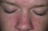علاج تقشر الوجه وجفافه