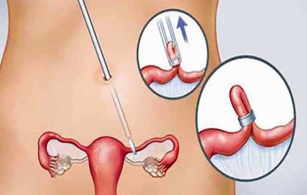 عملية ربط عنق الرحم لمنع الحمل